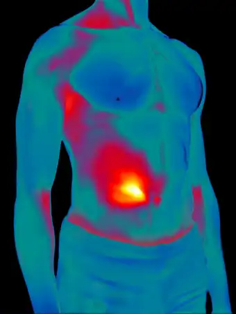 Inflamación intestinal crónica